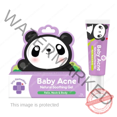 TinyBuds Baby Acne Soothing gel 20g
